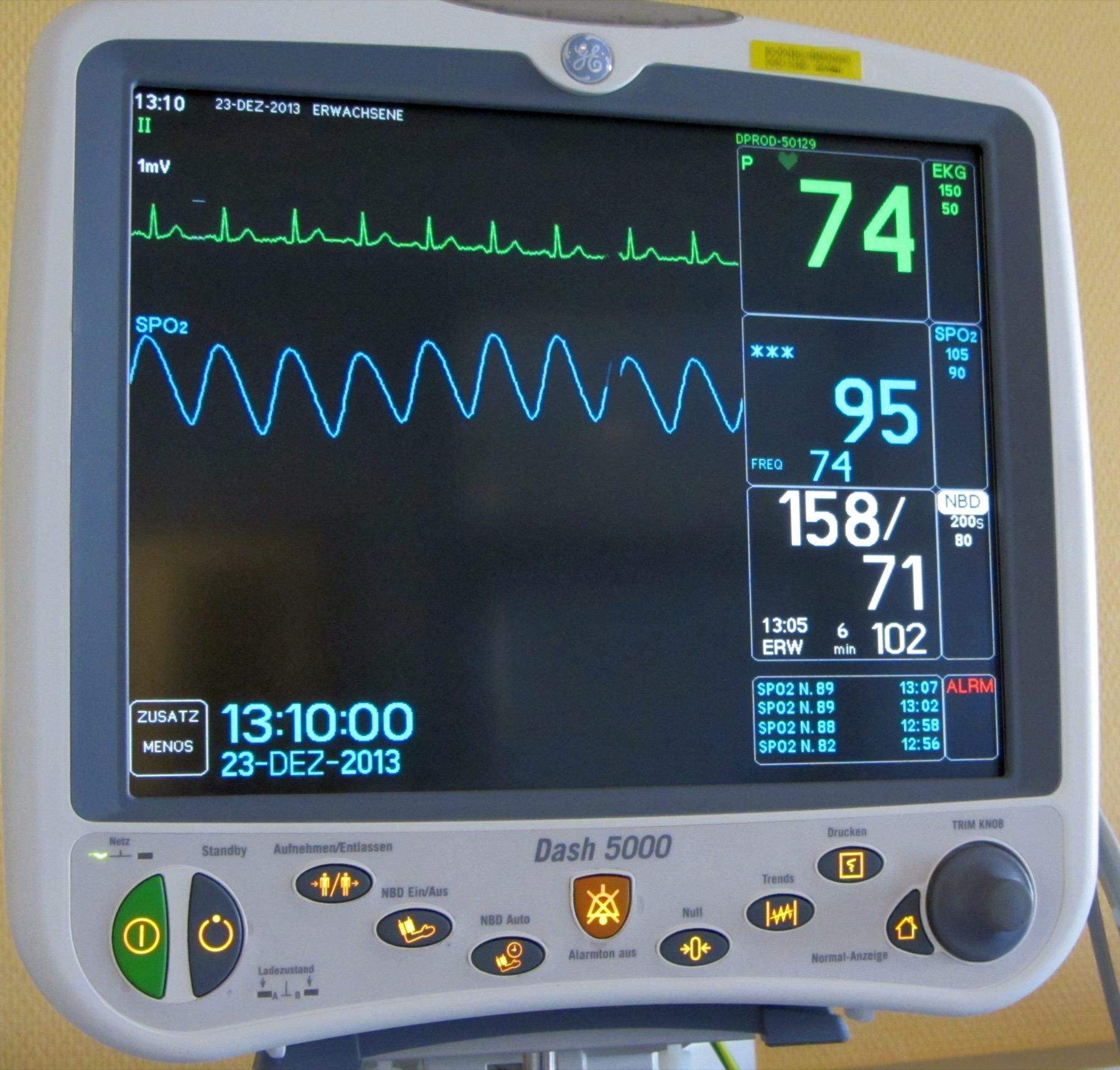 Patient monitor displaying waveforms and vital-sign values